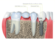 Straumann® Dental Implant Systemのコンセプト