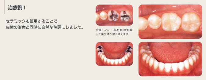 治療例1：セラミックを使用することで虫歯の治療と同時に自然な色調にしました。