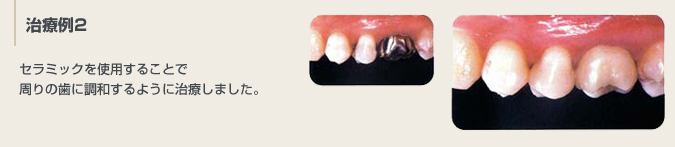 治療例2：セラミックを使用することで周りの歯に調和するように治療しました。